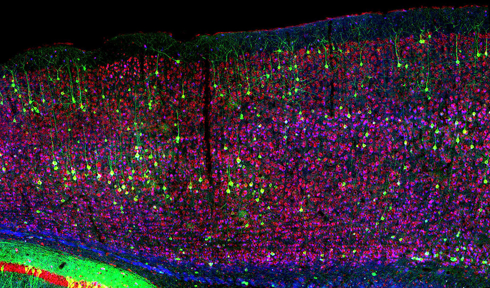 Particolare dei neuroni di una cavia affetta da una malattia neurodegenerativa